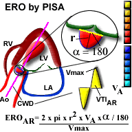 Aortic Valve Gradient