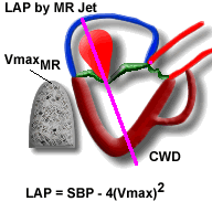 Aortic Valve Gradient