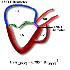 Aortic Valve Gradient